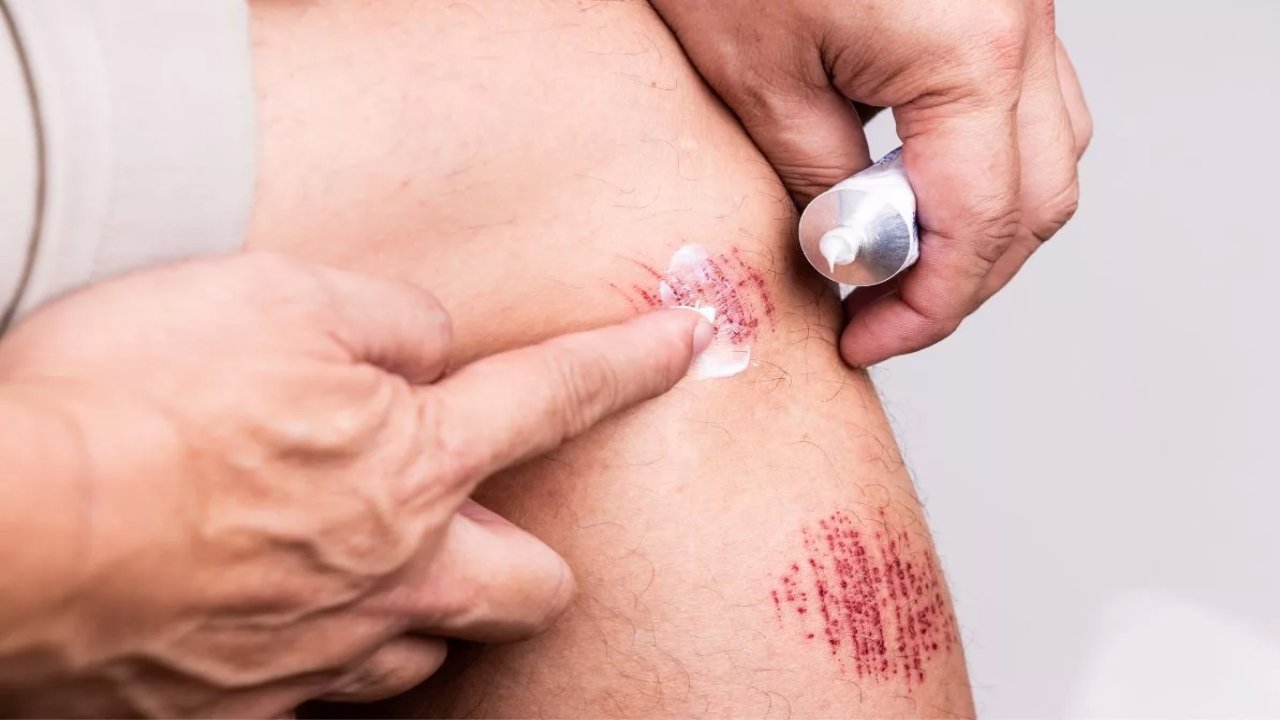 Preventing Infections in Minor Wounds
